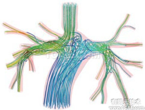 CFD模拟拯救患有致命心脏缺陷的婴儿