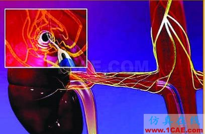 RF能量在医疗技术应用中的研究进展ansysem技术图片6